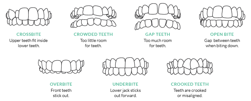 Invisalign Smile Assessment | Kelowna Dentist | Dr. Steve Johnson Dental Group